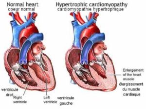 maladie cardiomyopathie hypertrophique féline
